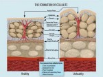 I rimedi per la cellulite